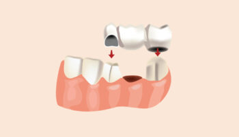 How a Single Missing Tooth Can Reshape Your Face (And How a Bridge Can Restore It)