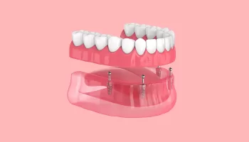 Restore Your Smile With Dental Implants in Youngtown